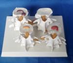 Vertebrae Diseased 4 Stage PVC Human Lumbar Spine Anatomy Model