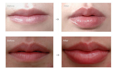 Beauty Care 1ml Hyaluronic Acid Dermal Filler With Lidocaine For Lip Enhancer