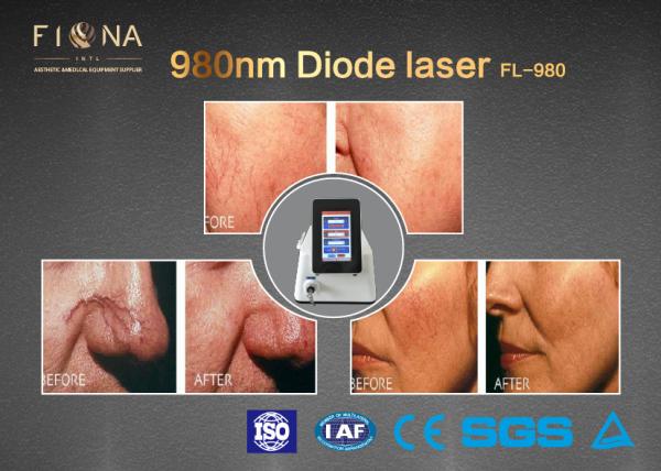 Professional Vascular Removal Spider Vein Removal Machine / spider vein vascular