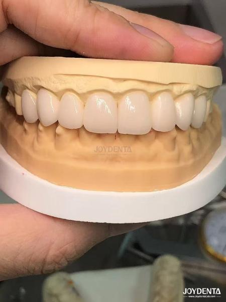 16 Shades Color Emax Dental Veneers A1-A4 High Stain Resistance For Perfectly