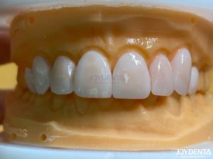 China Lightweight and Smooth Dental Veneers Stain Resistance Long-lasting Durability for Optimal Comfort wholesale