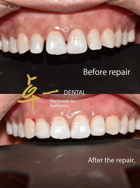 Say Hello To A Flawless Smile With Cosmetic Dental Veneers No Discoloration No