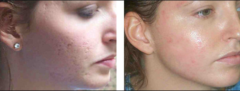 High Energy CO2 Fractional Laser Machine For Skin Scar Removal / Acne Treatment
