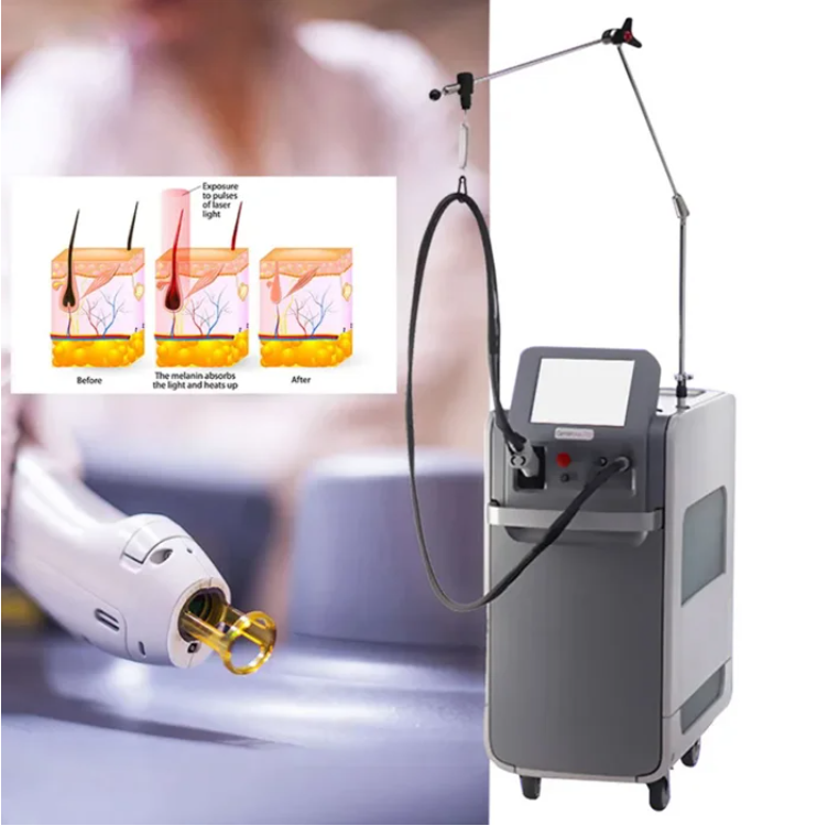 Long-Lasting Hair Removal Weifang KM 755nm Alexandrite 1064nm ND YAG Long Pulse Laser