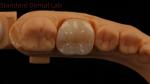 Dental Digital Full Zirconia Crown with Noritake Porcelain 3D Print Model 5 Year