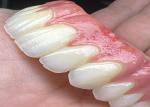 Oral Health Dental Implant Supported dentures Bridge Polished Surface Supporting