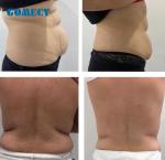 5 Wavelengths Lipolaser Slimming Machine Treatment Time 1-60mins