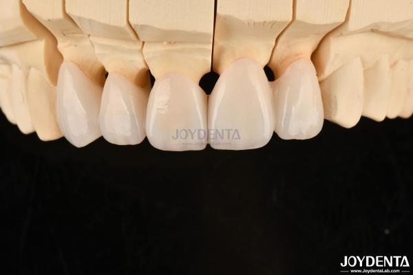Highly Customizable Layered Zirconia Dental Crowns And Bridges Long Lasting