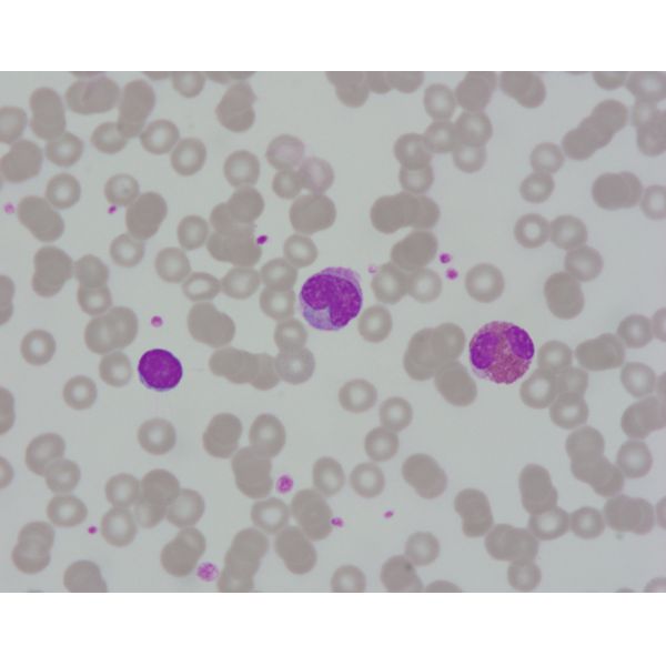 Modified Wright Giemsa Stain Solution For Staining Of Hematocytes In Blood And Marrow