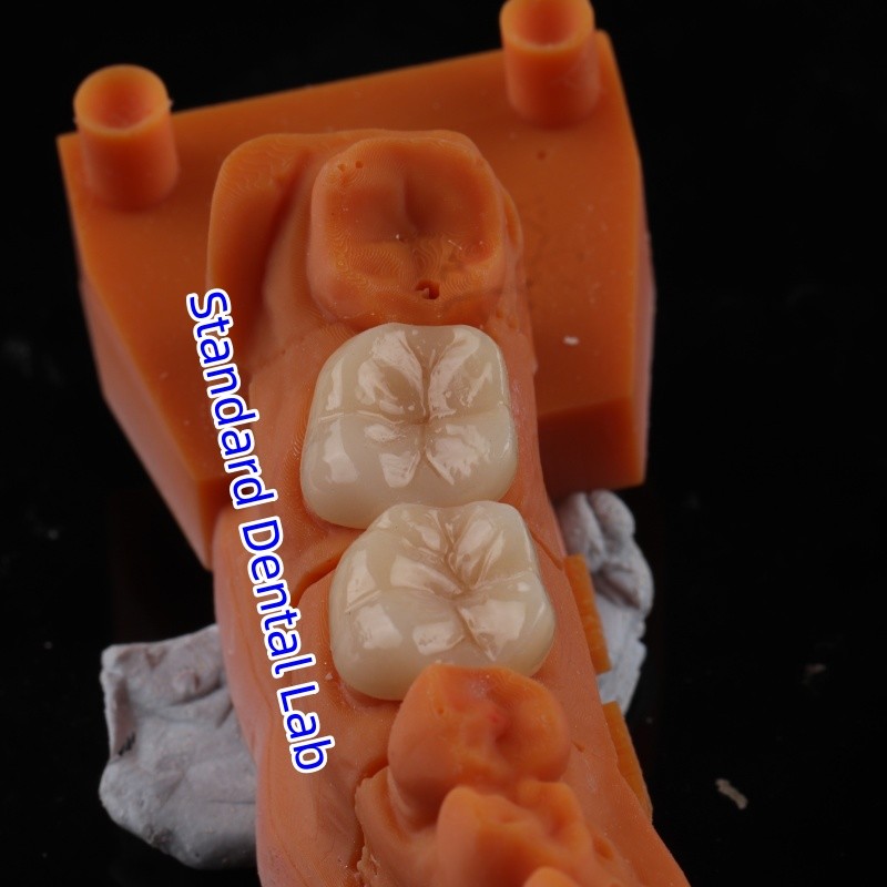 Full Contour Zirconia Crown Translucency 3D PRO No Porcelian Overlay Standard Dental Lab