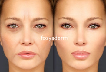 2ml HA Injectable Dermal Filler For Fine Wrinkles