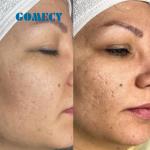 Blue Microneedle RF Machine for Scar Acne Wrinkle Removal 10-150mj/pin Energy