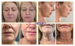 2024 Newest Hifu Small Face Lifting Hifu High Intensity Focused Facial Skin