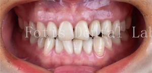 China Cosmetic Dentistry Dental Porcelain Veneers With High Stain Resistance wholesale