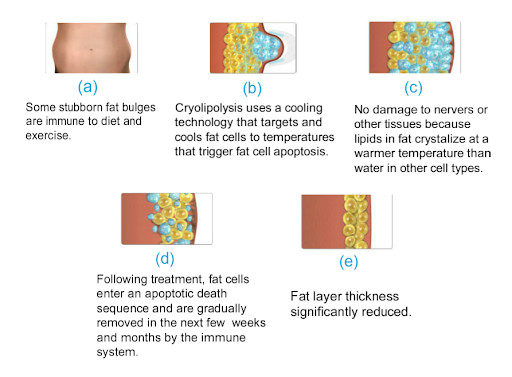 Multifunction Body Sculpture 10.4" Cryolipolysis Equipment