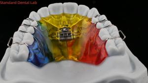 China Teeth Expansion And Distalization Orthodontist Palate Expander China Dental Lab wholesale