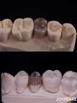 Customizable Affordable Dental Inlay Restorative Precise Fit For Damaged Teeth
