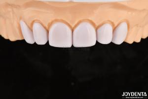 China Dental Veneers for Misaligned Teeth Biocompatibility And Gentle On Oral Tissues wholesale