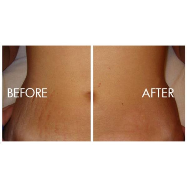 Fractional Co2 Laser Skin Resurfacing Machine For Stretch Marks Elimination