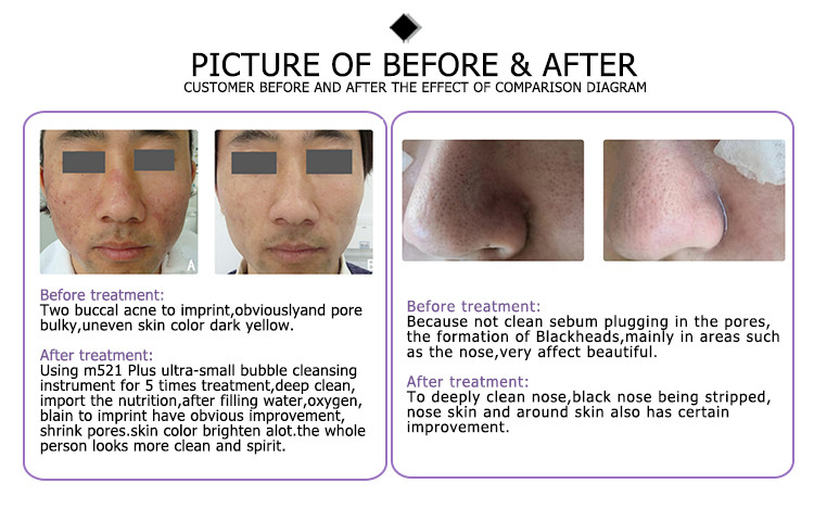 skin polishing equipment high quality mask sincoheren microdermabrasion diamond beauty machine vortexs hydrafacials
