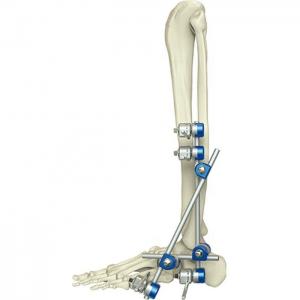 China Medical Orthopedic Instrument Ankle External Fixation Device wholesale