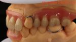 Heat Cured Ivoclar Partial Acrylic Denture Dental Lab High Accuracy with 3D
