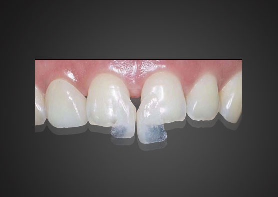 IPS 0.2mm Ultra Thin Emax Veneers Stain Resistant With High Strength