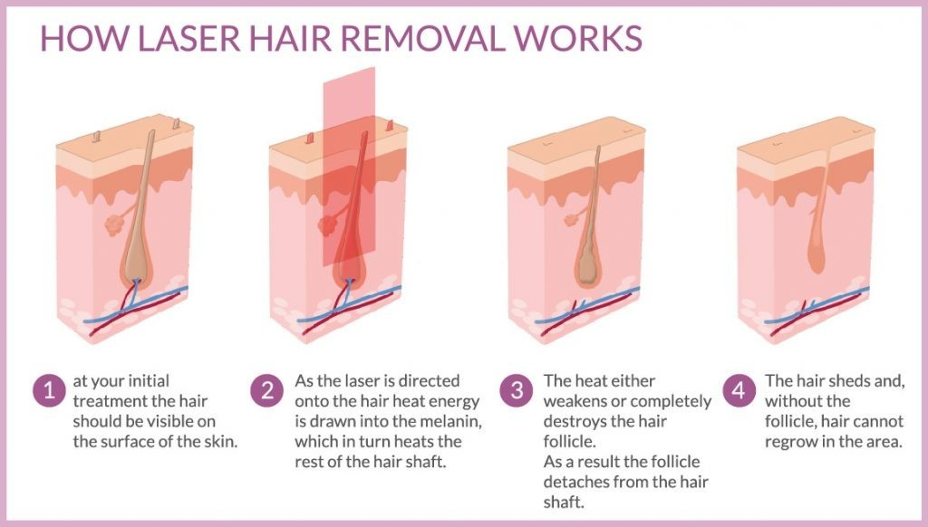 808 Laser Beauty Equipment Diode Painless Fast Hair Removal Machine