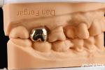 Metallic Material Dental Gold Crown , Gold Tooth Crown For Optimal Oral