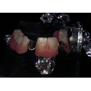Openresty Server Software Based Metal Framework Partial Dentures Featuring