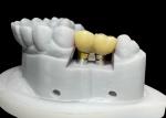 Dental Implant with Ceramic Crown and titanium Abutment for molar