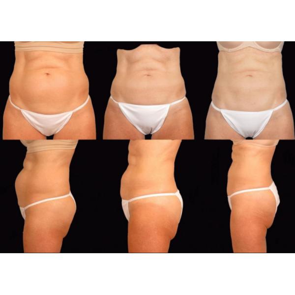Multifunction Body Sculpture 10.4" Cryolipolysis Equipment