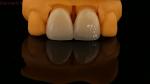 5 Year Guarantee Full Contour Zirconia Crown Customized Vita Shade High