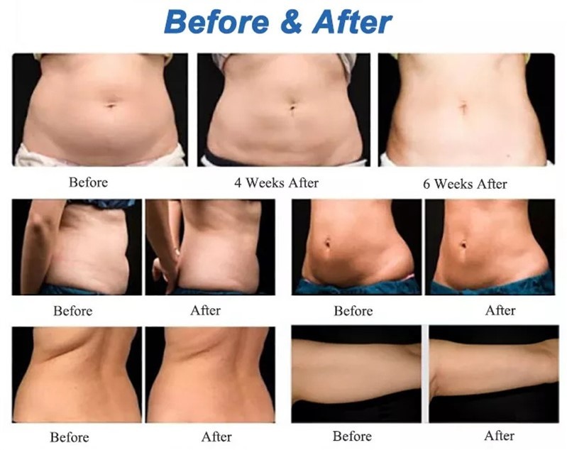 Portable 650nm Lipo Laser Machine Ultrashape Body Slimming Weight Loss