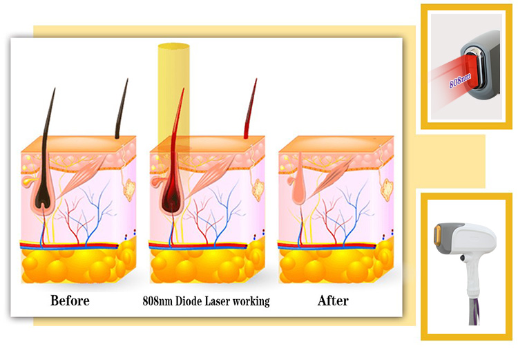 Permanent Hair Removal 808nm Diode Laser Hair Removal Beauty Machine