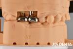 Single Or Multiple Restorations Dental Abutments And Bars With Internal Hex