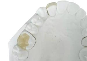 China Durable Flexible PFM Bridge Crown Dental IPS E Max Press Inlay Onlay wholesale