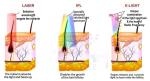 4 In1 808NM Hair Removal Diode Laser Tattoo Removal Q Switched Nd Yag Laser IPL