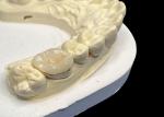 Hypoallergenic Porcelain Inlays Onlays for Teeth Repair Natural Color and Easy
