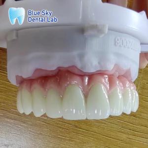 China Metal Frame Titanium Malo Bridge Customizable Malo Implant Bridge wholesale