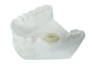 China Durable FDA All-Ceramic Dental Crown Veneer Inlay Onlay Similar wholesale