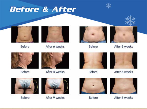 2017 Newest Professional Cryolipolysis Slimming Machine