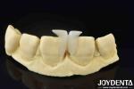 Customizable Smooth Micro Thin Veneers Long Lasting Natural Looking Veneers