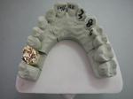 Full Metal PFM Dental Crown Bridge High Tech Biological Material