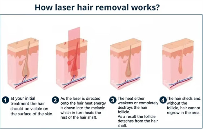 IPL Crystal Effective Painless IPL Laser Hair Removal Skin Rejuvenation Device