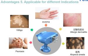 China Treat Vitiligo 308NM Excimer Psoriasis Laser Machine Blue Light Color wholesale