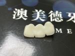 Precise Fit Ceramic Crown Bridge with Strong Porcelain and Natural Aesthetic