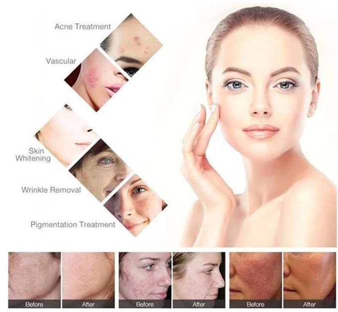 OPT SHR Epilation IPL Laser Hair Removal Machine 2000W 1-10Hz