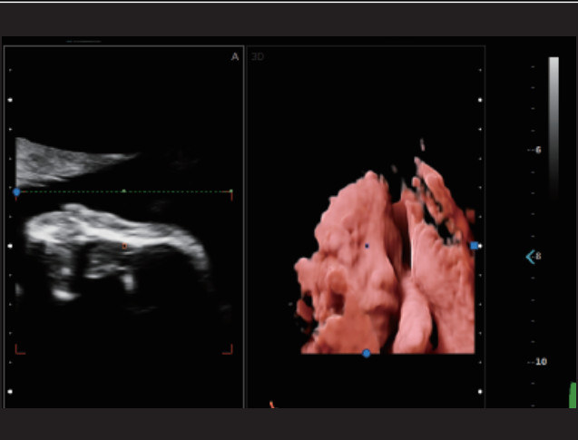 Fetal Doppler Medical Ultrasound Machine Trolley 3D 4D 5D
