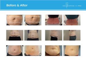 China China top 10 supplier's CE approved 4 handles coolsculpting technology fat freeze body slimming machine for weight loss wholesale